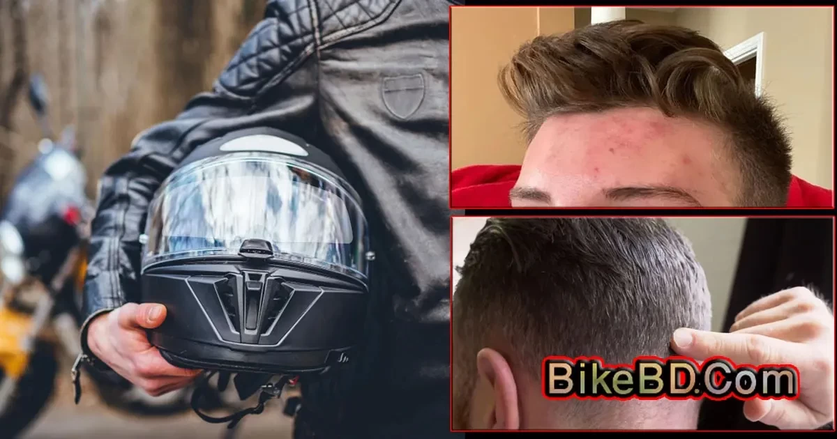 How To Prevent Helmet Acne And Keep Our Skin Healthy?